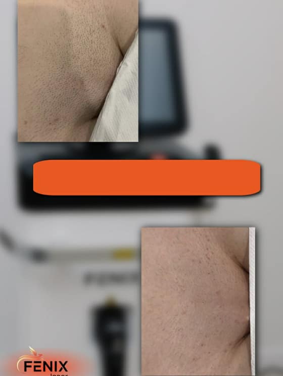 laserova-epilacia--depilacia-fc092e0b-e62e-4067-a054-91dfe5fbb098.jpg
